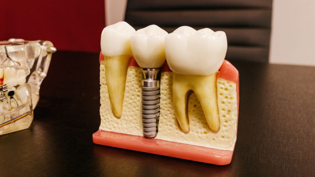 Dental Implants 4 Dental Implants | halihan 2 | Family Dentistry of Crystal Lake