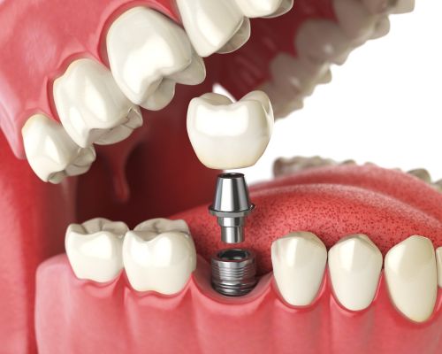 Dental Implant Services 5 Diseño sin título (2)