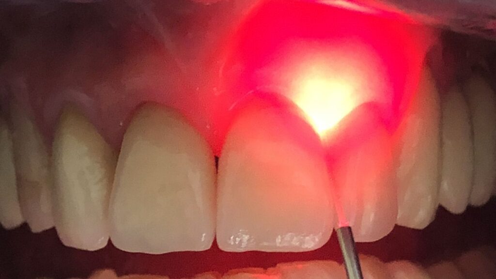 Laser Dentistry 7 Laser Dentistry | Randy Halihan Family Dentistry 19 1 | Family Dentistry of Crystal Lake
