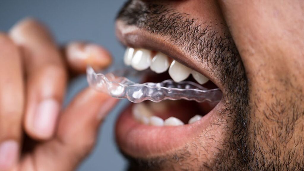 Mouthguards 4 Mouthguards | Randy Halihan Family Dentistry 20 2 | Family Dentistry of Crystal Lake