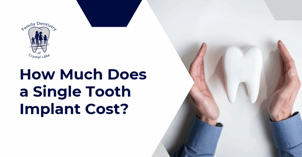 How Much Does a Single Tooth Implant Cost? 21 A visual breakdown of the cost of single tooth implants, featuring a large model tooth protected by open hands.