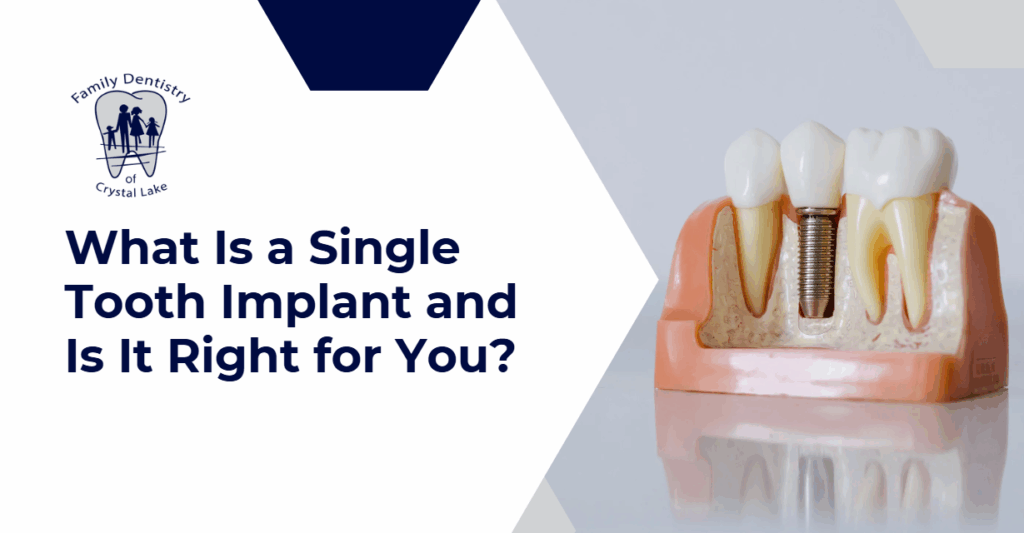 What Is a Single Tooth Implant and Is It Right for You? 26 What Is a Single Tooth Implant and Is It Right for You? | unnamed 2025 05 27T174711.813 | Family Dentistry of Crystal Lake