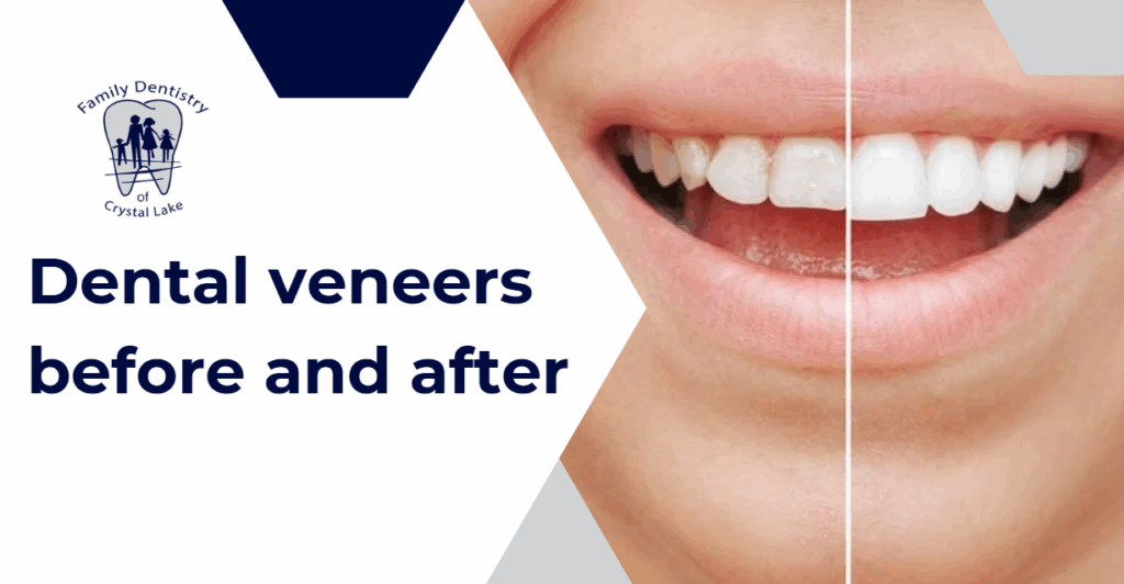 How Veneers Enhance Your Teeth for a Flawless Look 35 How Veneers Enhance Your Teeth for a Flawless Look | unnamed 2025 05 27T233330.198 | Family Dentistry of Crystal Lake