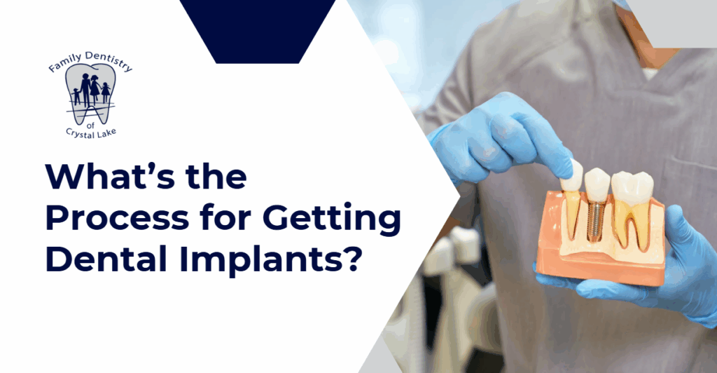 What’s the Process for Getting Dental Implants? 5 (Dental professional in gloves holding a tooth model and pointing to a dental implant, with text asking about the process for getting dental implants.)