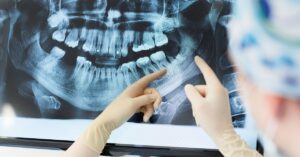 How Much Does a Tooth Implant Cost in Crystal Lake? 2 dental x-ray showing implant placement