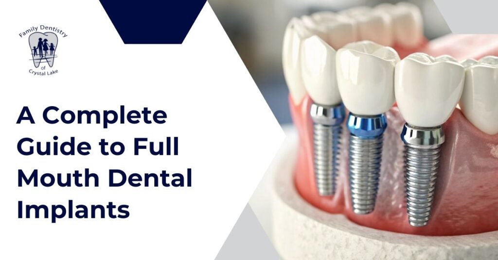 A Complete Guide to Full Mouth Dental Implants 9 Dentist explaining full mouth dental implant procedure to patient