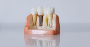 A Complete Guide to Full Mouth Dental Implants 2 full mouth dental implant model showing arch support”)