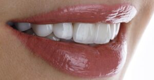 Cosmetic Dentistry in Crystal Lake | Transform Your Smile with Modern Solutions 1 Before and after cosmetic dentistry veneers in Crystal Lake