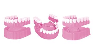 Affordable Dentures: Restoring Your Smile Without Breaking the Bank 2 full, partial, and implant-supported dentures