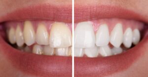 Cosmetic Dentistry in Crystal Lake | Transform Your Smile with Modern Solutions 2 Professional teeth whitening procedure at Crystal Lake dental office