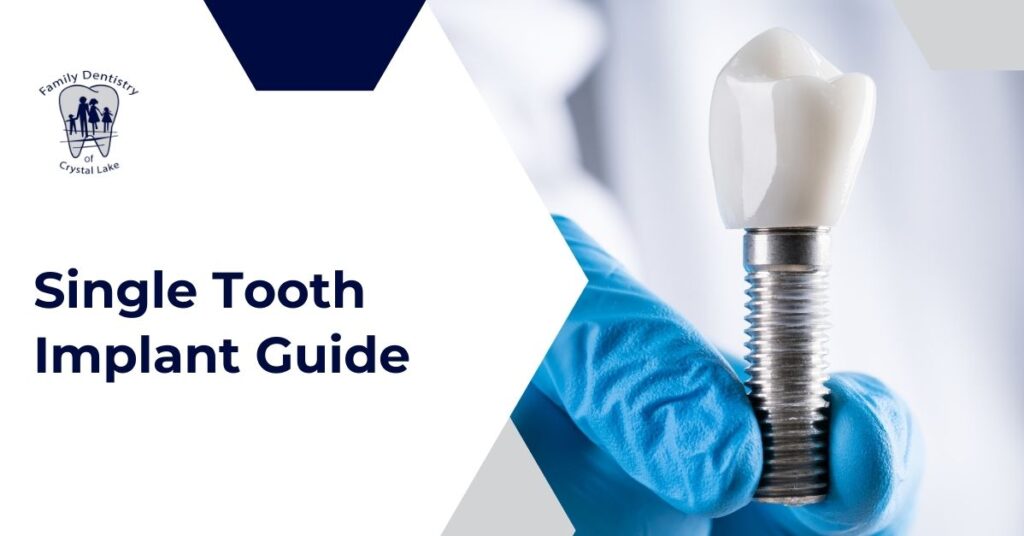Everything You Need to Know About a Single Tooth Implant 22 Dentist showing single tooth implant model to patient