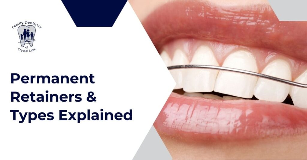 Permanent Retainers and Other Types: How to Choose and Care for Yours 19 Different types of dental retainers and cleaning tips