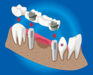 Can a Tooth or Dental Implant Break? How to Protect Your Smile Long-Term 2 Visual diagram illustrating the structure and function of a dental implant.