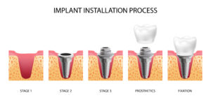 How Long Do Dental Implants Last? What to Expect from Start to Finish 2 Diagram illustrating the dental implant process from placement to crown.