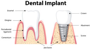 How Long Do Dental Implants Last? What to Expect from Start to Finish 1 Illustration explaining how a dental implant is placed into the jawbone.