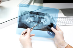Can Diabetics Get Dental Implants? What You Need to Know Before Treatment 1 Dental X-ray image displaying teeth roots and jawbone.