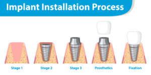 Full Mouth Dental Implants After Years of Dentures: What Are Your Options? 2 Infographic of human in implant installation process illustration