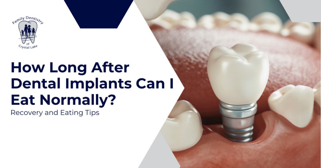 How Long After Dental Implants Can I Eat Normally? Recovery and Eating Tips 9 How Long After Dental Implants Can I Eat Normally? Recovery and Eating Tips | FDC Cover Can a Tooth or Dental Implant Break How to Protect Your Smile Long Term | Family Dentistry of Crystal Lake