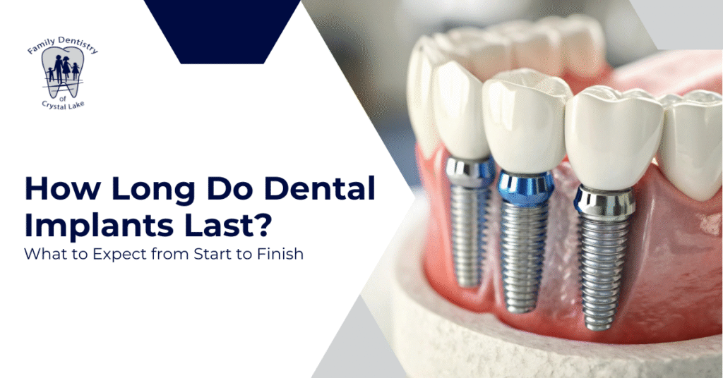 How Long Do Dental Implants Last? What to Expect from Start to Finish 1 How Long Do Dental Implants Last? What to Expect from Start to Finish | FDC Cover How Long Do Dental Implants Last What to Expect from Start to Finish | Family Dentistry of Crystal Lake
