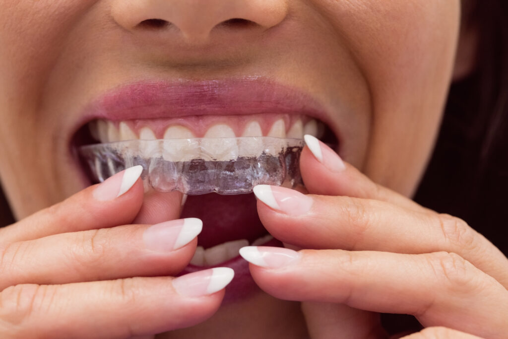 SureSmile Clear Aligners 1 SureSmile Clear Aligners | female patient wearing braces | Family Dentistry of Crystal Lake