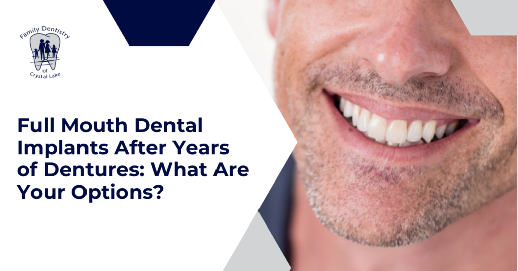 Full Mouth Dental Implants After Years of Dentures: What Are Your Options? 19 Full Mouth Dental Implants After Years of Dentures: What Are Your Options? | FDC Cover Full Mouth Dental Implants After Years of Dentures What Are Your Options | Family Dentistry of Crystal Lake