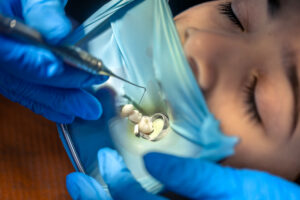 Dental Sealants for Children in Crystal Lake: Extra Protection for Young Smiles 1 What Are Dental Sealants and How Do They Work?