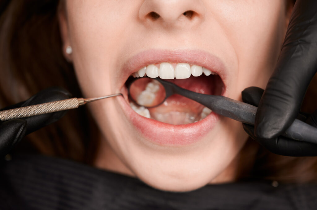 Composite (Tooth-Colored) Fillings 14 Composite (Tooth-Colored) Fillings