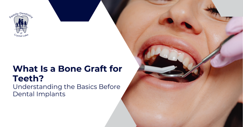 What Is a Bone Graft for Teeth? Understanding the Basics Before Dental Implants 1 What Is a Bone Graft for Teeth? Understanding the Basics Before Dental Implants