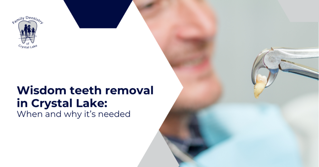 Wisdom Teeth Removal in Crystal Lake: When and Why It’s Needed 19 Wisdom Teeth Removal in Crystal Lake: When and Why It’s Needed
