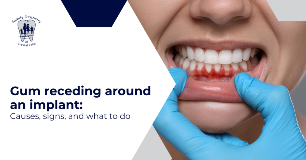 Gum Receding Around an Implant: Causes, Signs, and What to Do 22 Gum Receding Around an Implant: Causes, Signs, and What to Do