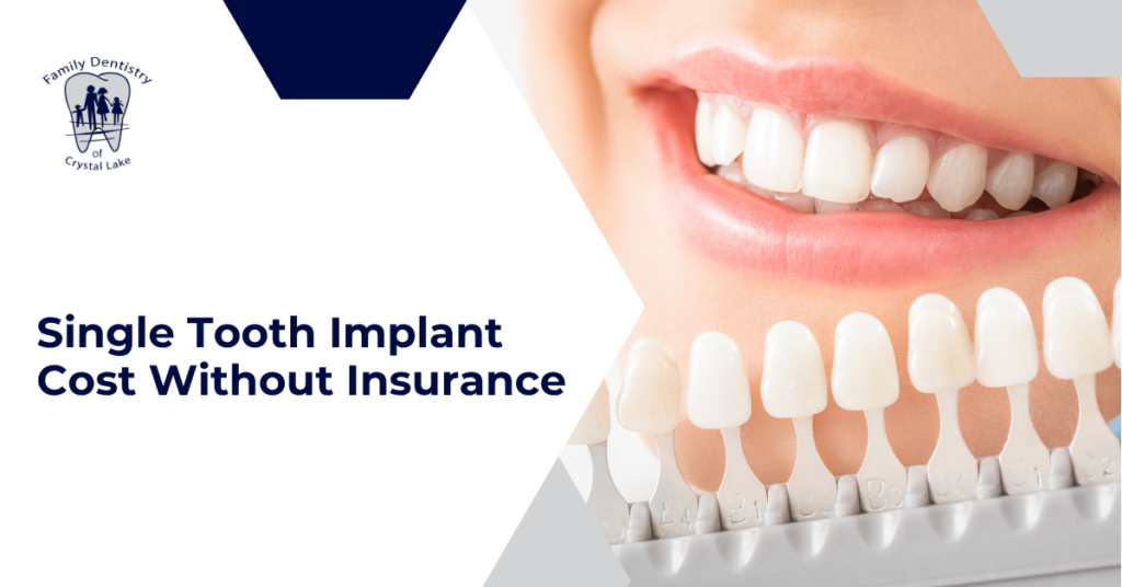 Single Tooth Implant Cost Without Insurance