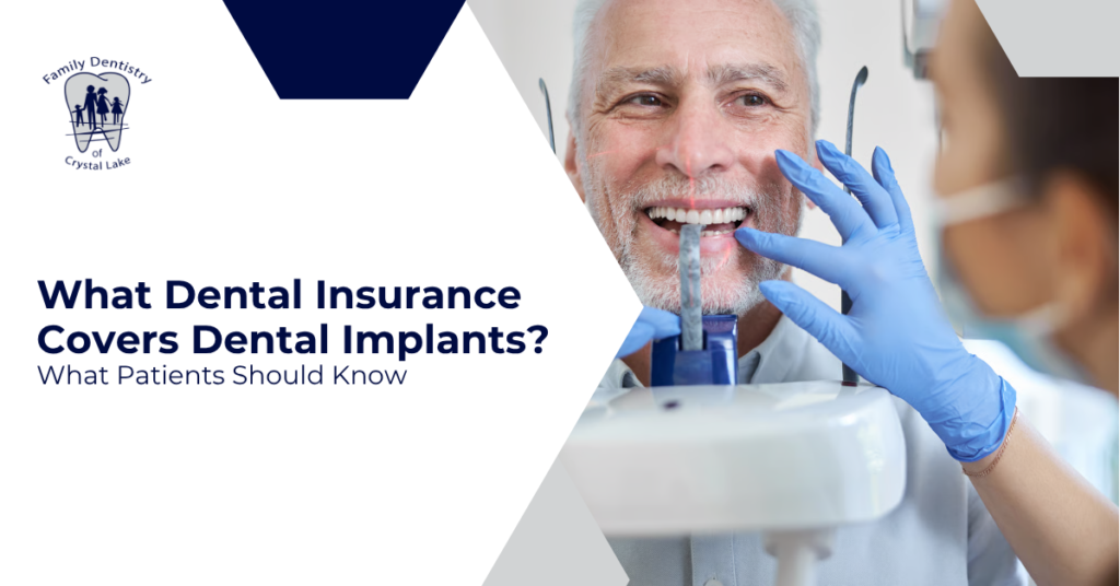 What Dental Insurance Covers Dental Implants? What Patients Should Know 19 What Dental Insurance Covers Dental Implants? What Patients Should Know