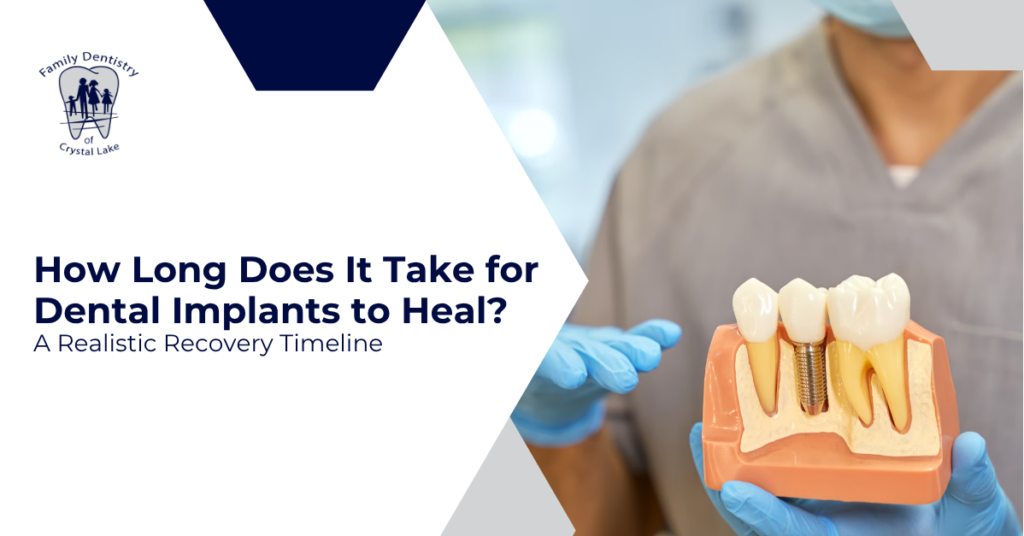 How Long Does It Take for Dental Implants to Heal? A Realistic Recovery Timeline