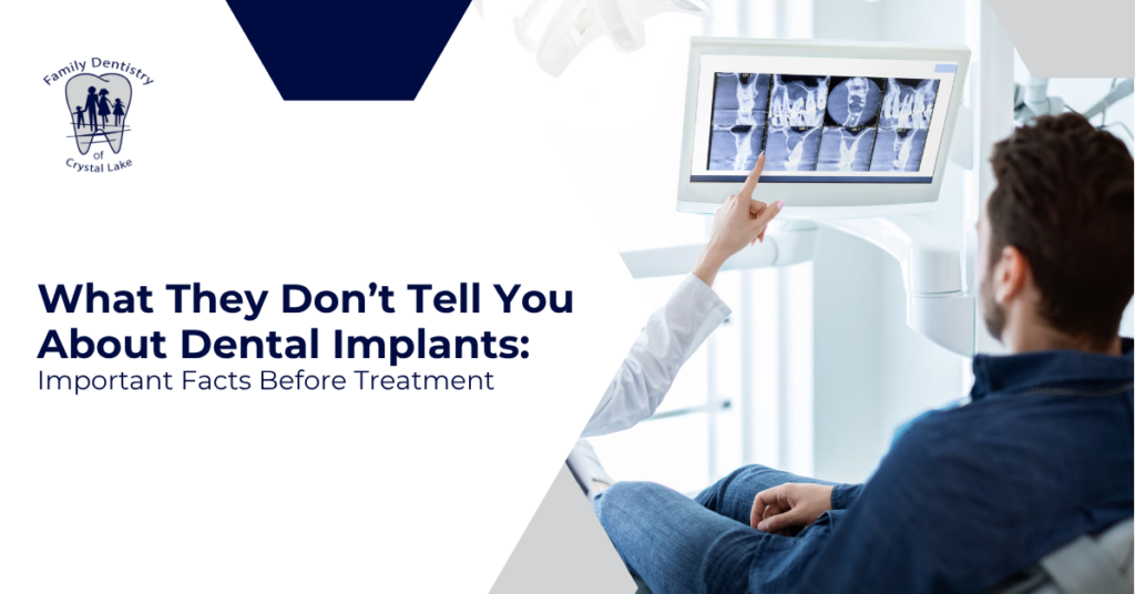 What They Don’t Tell You About Dental Implants: Important Facts Before Treatment 16 What They Don’t Tell You About Dental Implants: Important Facts Before Treatment