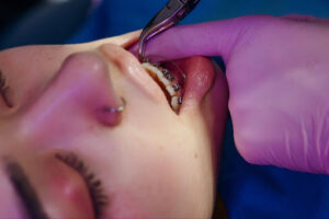 Teen Orthodontic Readiness: When Should Your Teenager Get Braces? 1 Teen patient receiving braces adjustment during an orthodontic treatment appointment