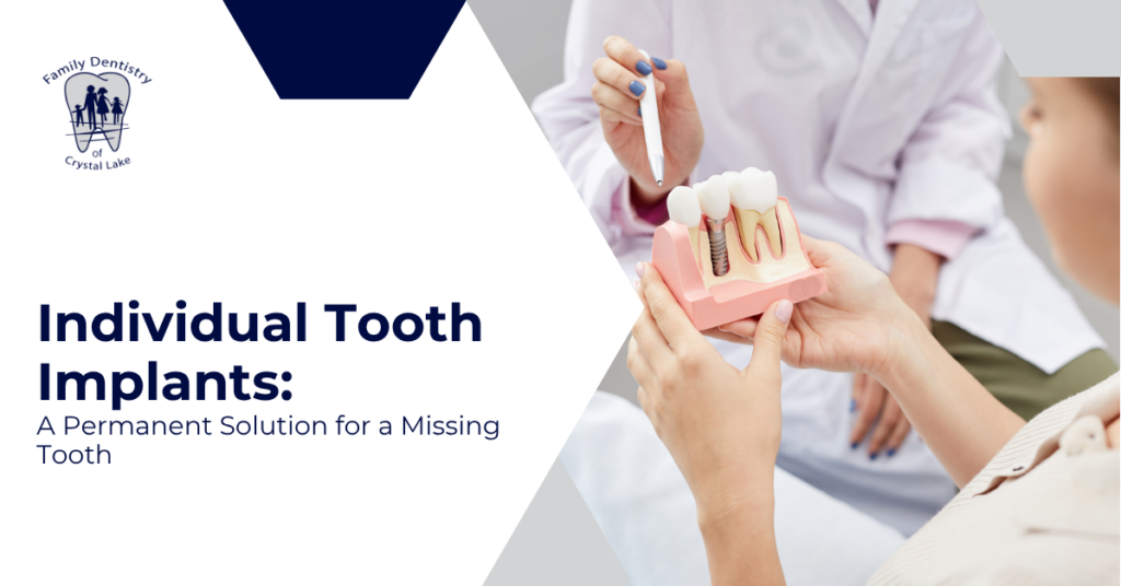 Individual Tooth Implants: A Permanent Solution for a Missing Tooth