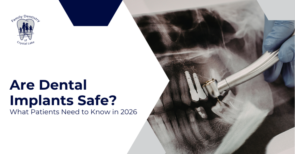Are Dental Implants Safe? What Patients Need to Know in 2026