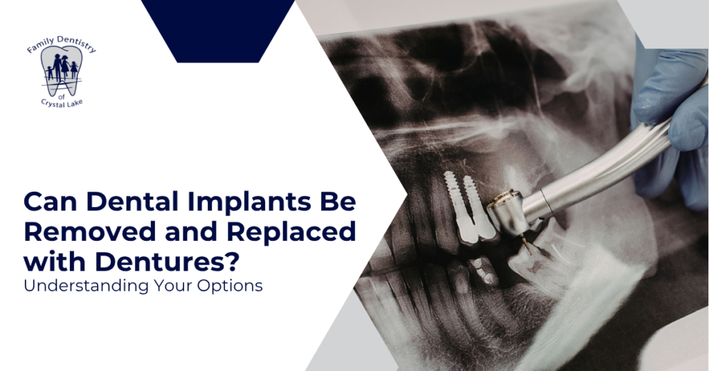 Can Dental Implants Be Removed and Replaced with Dentures? Understanding Your Options 13 Can Dental Implants Be Removed and Replaced with Dentures? Understanding Your Options | FDCL covers JULY2 | Family Dentistry of Crystal Lake
