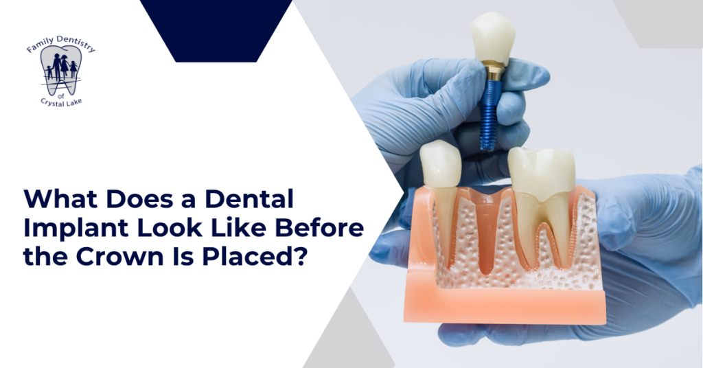 What Does a Dental Implant Look Like Before the Crown Is Placed?