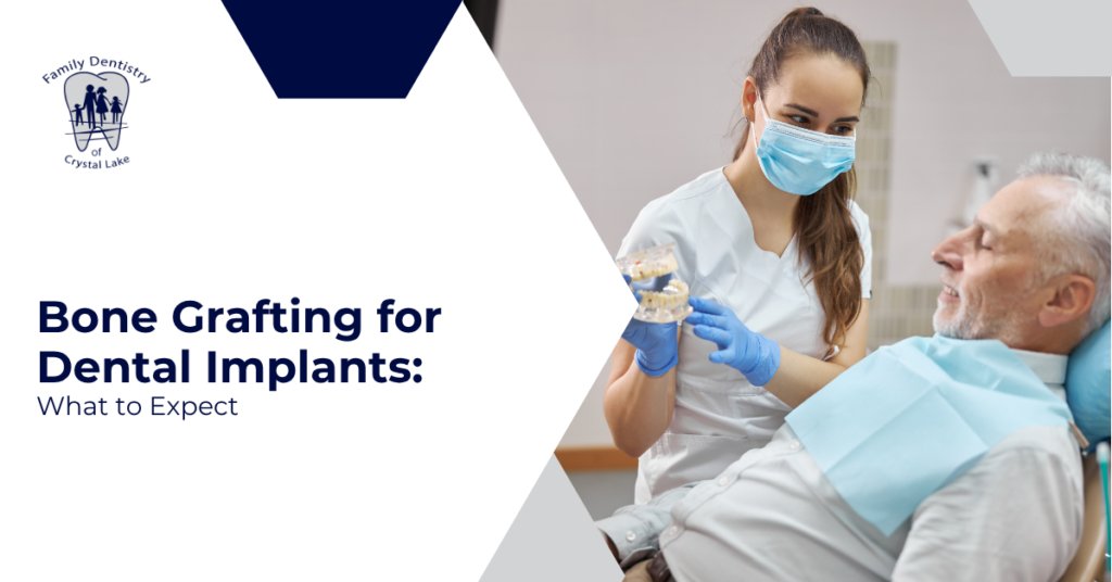 Bone Grafting for Dental Implants: What to Expect
