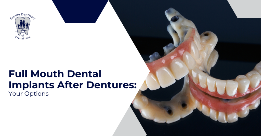Full Mouth Dental Implants After Dentures: Your Options