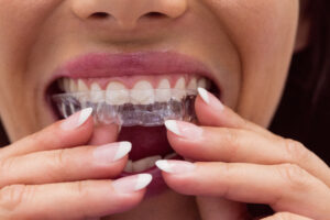 Sports Mouthguards for Kids in Crystal Lake: Why Fall Sports Season Is the Right Time to Get Fitted 2 Dentist fitting a clear orthodontic aligner for a male patient during treatment.
