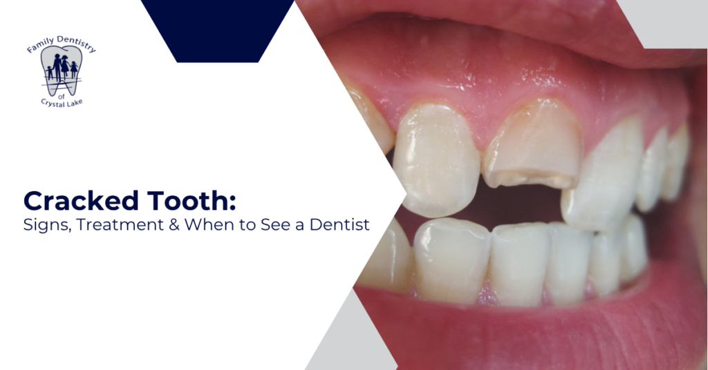 Cracked Tooth: Signs, Treatment & When to See a Dentist