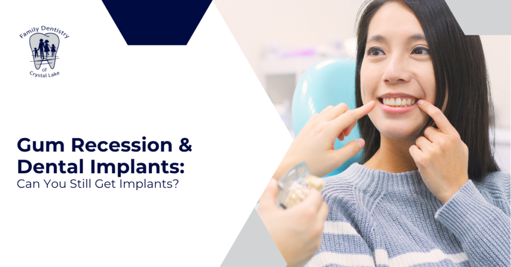 Gum Recession & Dental Implants: Can You Still Get Implants? 13 Gum Recession & Dental Implants: Can You Still Get Implants?