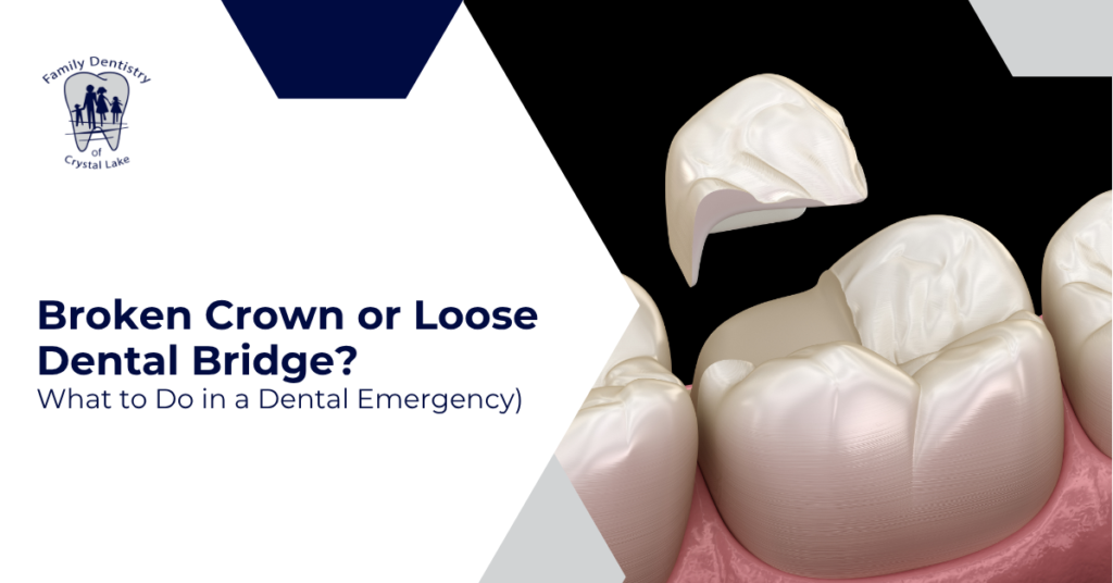 Broken Crown or Loose Dental Bridge: What to Do in a Dental Emergency
