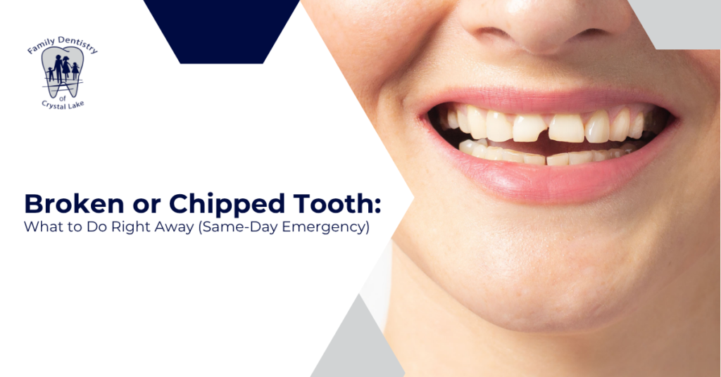 Broken or Chipped Tooth: What to Do Right Away (Same-Day Emergency)