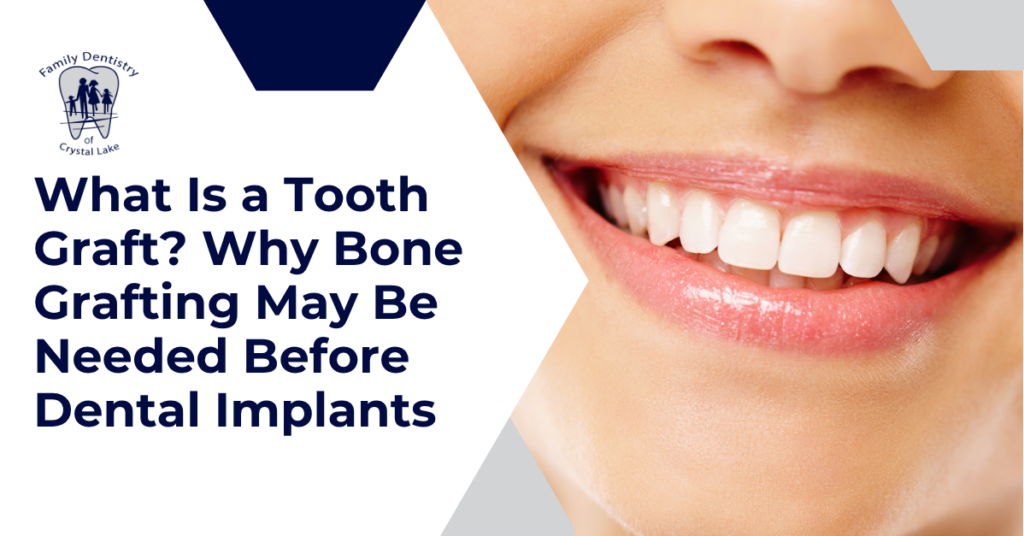 What Is a Tooth Graft? Why Bone Grafting May Be Needed Before Dental Implants 1 What Is a Tooth Graft? Why Bone Grafting May Be Needed Before Dental Implants